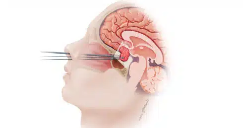 endonasal