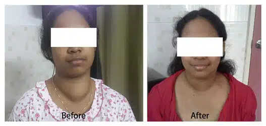 endoscopic-thyroidectomy-no-scar