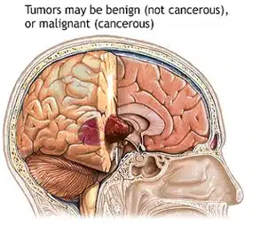 india-sugery-brain-tumors-treatment12