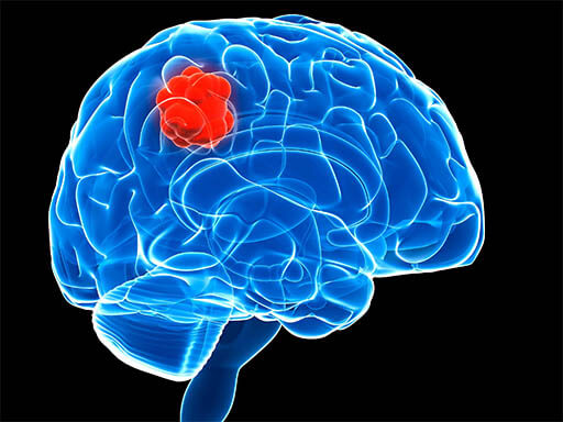meningiomaiansuk23