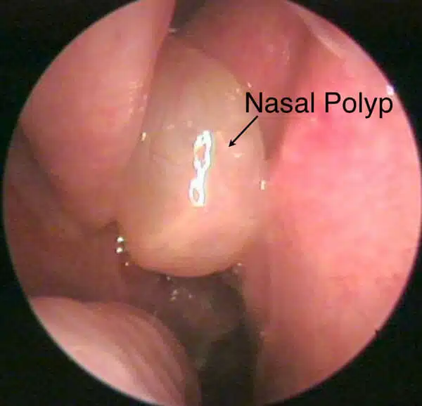 nasal-polyp1