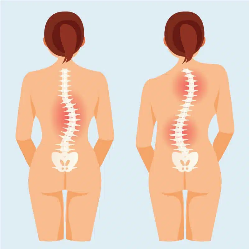 scoliosis-newport-beach