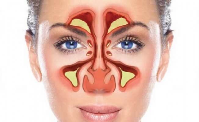 sinuzit-nedir-neden-olan-durumlar-nedir-nasil-tedavi-edilir_5146a
