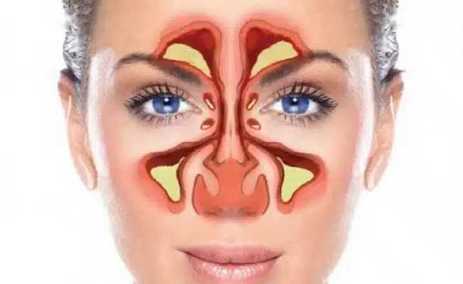 sinuzit-nedir-neden-olan-durumlar-nedir-nasil-tedavi-edilir_5146a