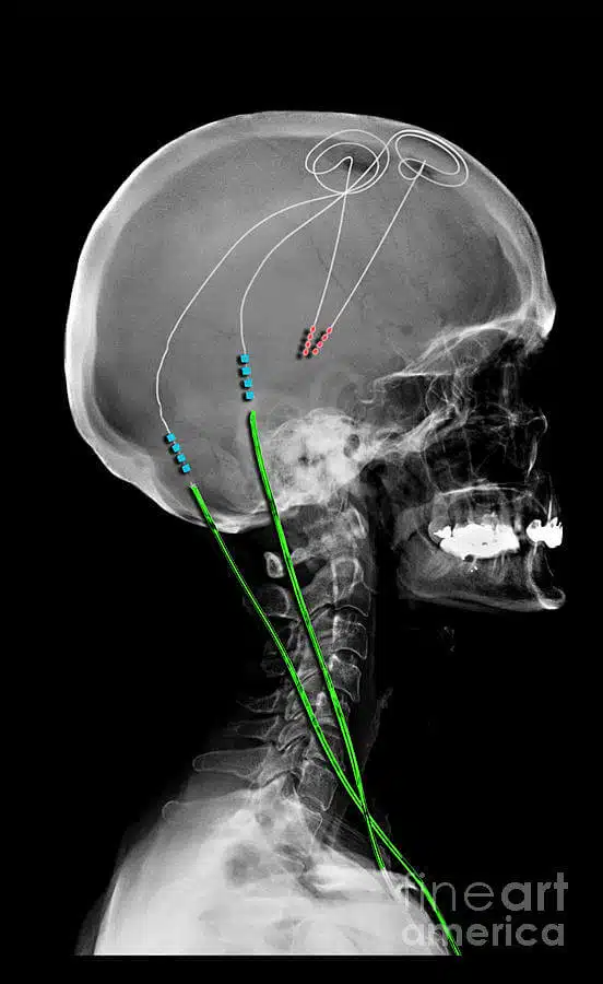 1-parkinsons-disease-with-dbs-electrodes-living-art-enterprises
