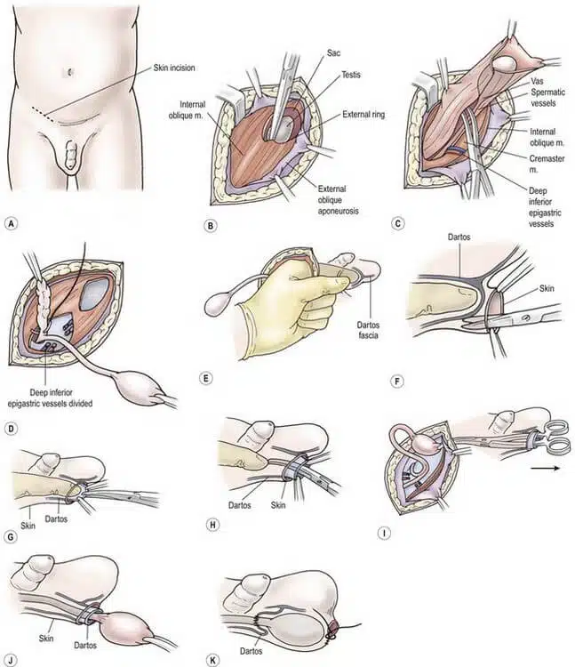 Testicular torsion
