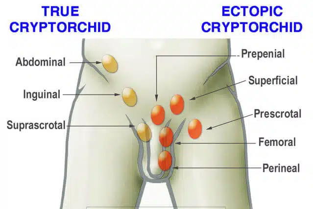 cryptorchidism-types