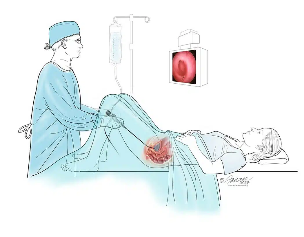 cystoscopy-procedure844