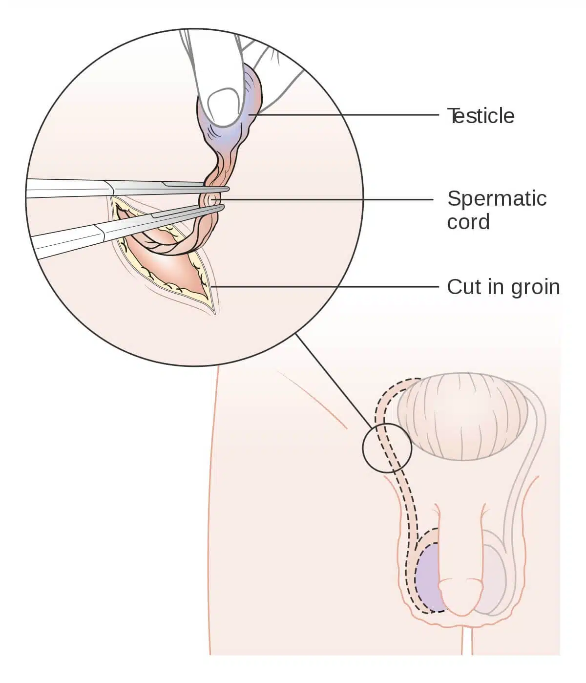 diagram_showing_how_the_testicle_is_removed_orchidectomy_cruk_1412