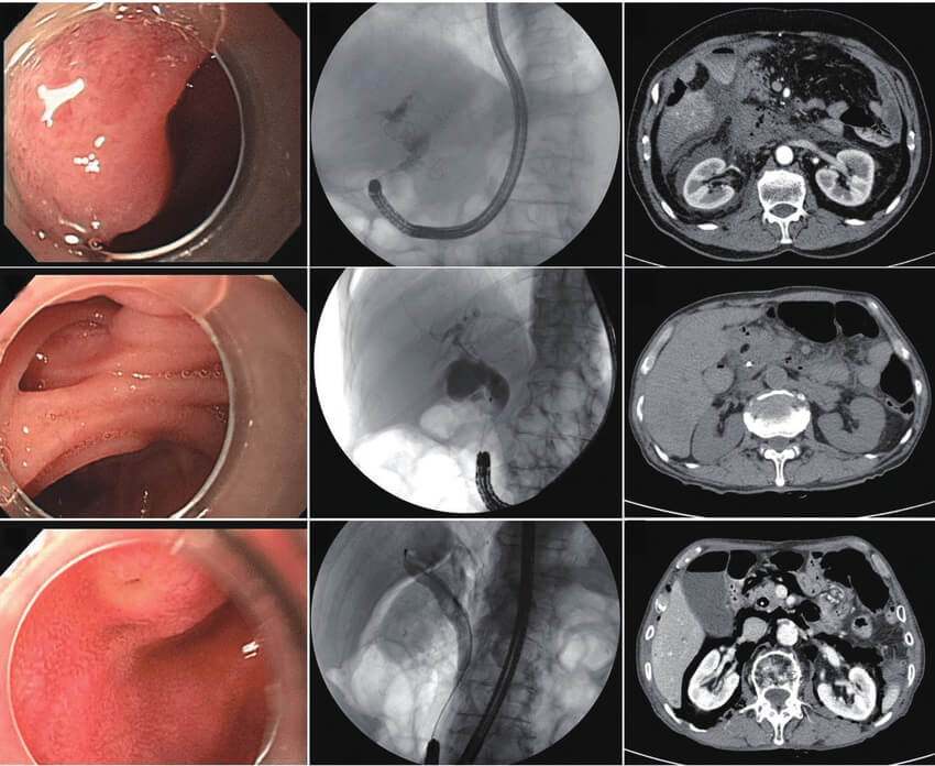 endoscopic-retrograde-cholangiopancreatography-findings-of-endoscopic-view-and