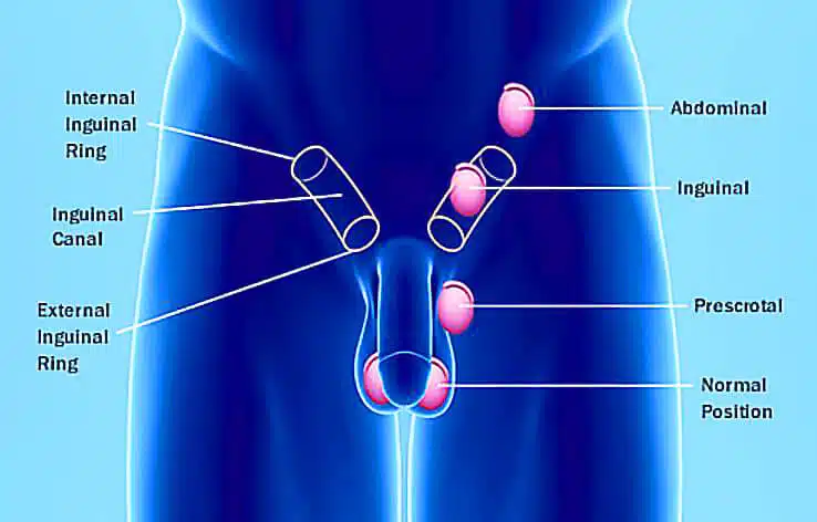 testicular-cancer-lump22