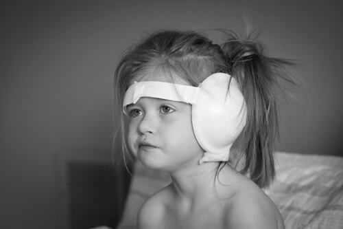tympanoplasty