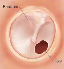 eardrum-with-hole-373827