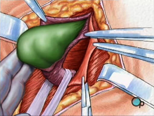 hernia-repair-inguinal-open