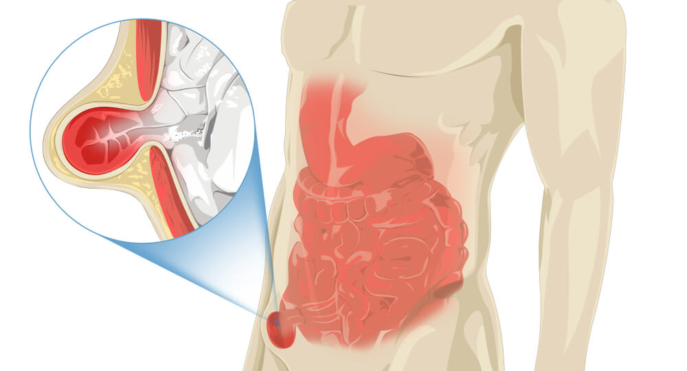 illustration-stomach-pain-in-inguinal
