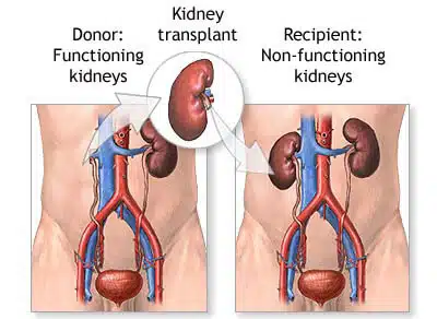kidney-transplant