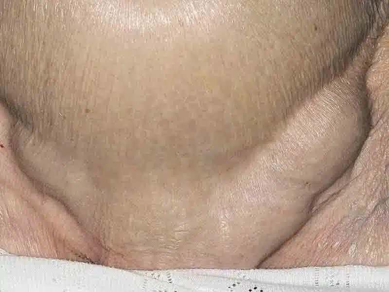 ps_171017_bilateral_inguinal_hernia2