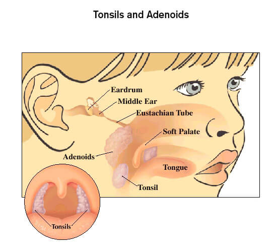 tonsils-and-adenoids