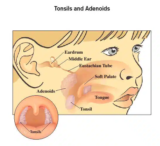 tonsils-and-adenoids
