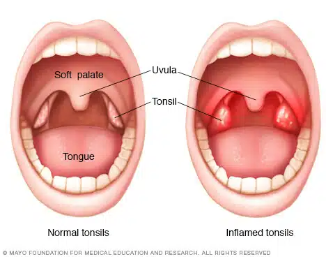 tonsils