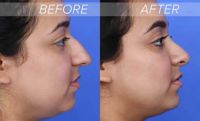 hook-nose-rhinoplasty-before-and-after-20315