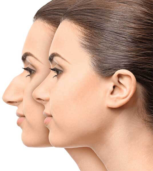 original_rhinoplasty-2