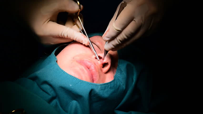 rhinoplasty-before-and-after-b