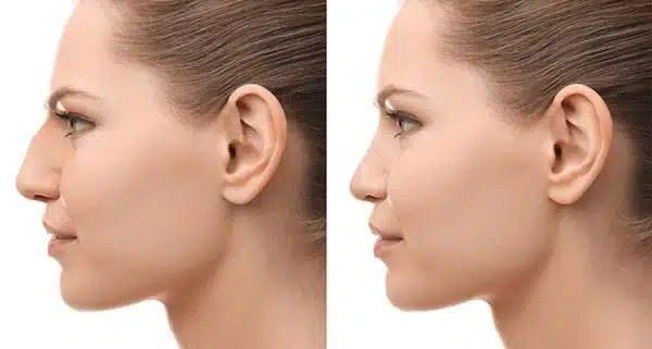 rhinoplasty-female-2