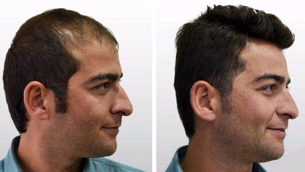 hair-transplantation-in-keha-skin-2-1024x576