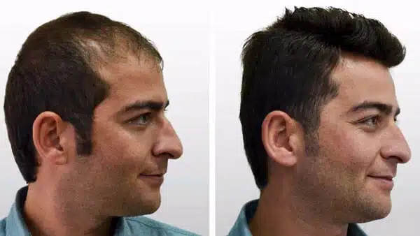 hair-transplantation-in-keha-skin-2-1024x576