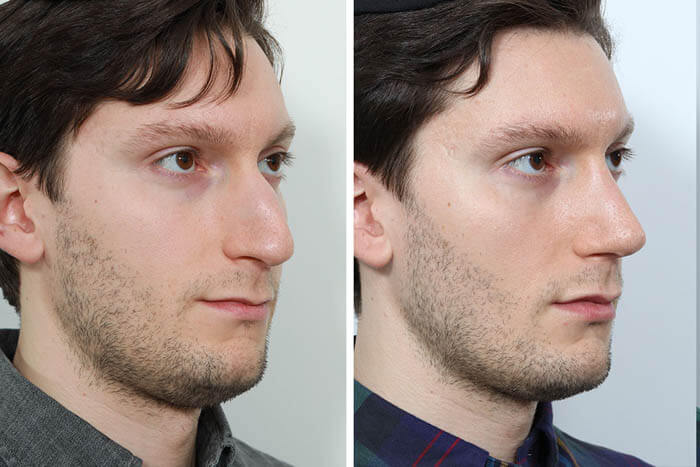 rhinoplasty-311-1