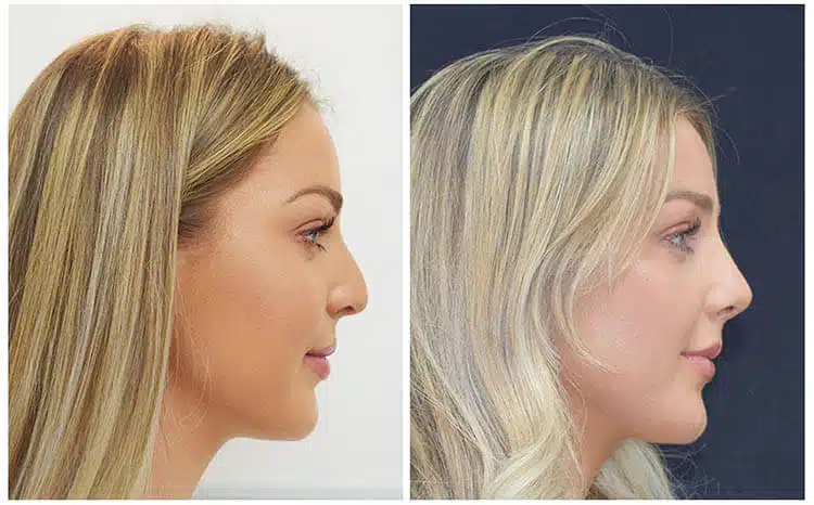 best-rhinoplasty-surgeon-before-after-results-002