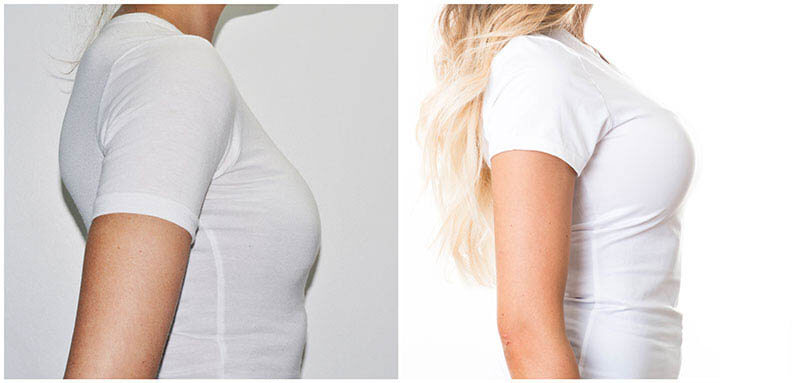 breast-implant-enlargement-augmentation-before-after-results-buckinghamshire-london