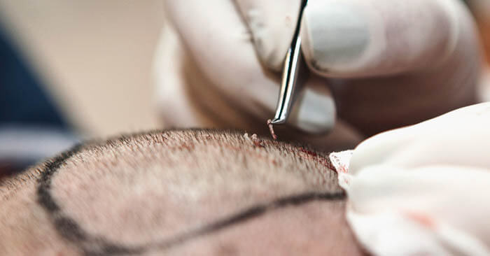 hair-transplant-in-iran-222245
