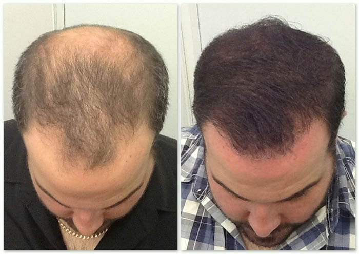 new-hair-clinic-result1