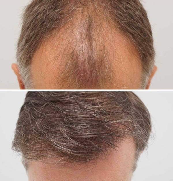 hair-loss-2