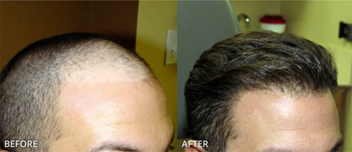 hair-transplant-2019