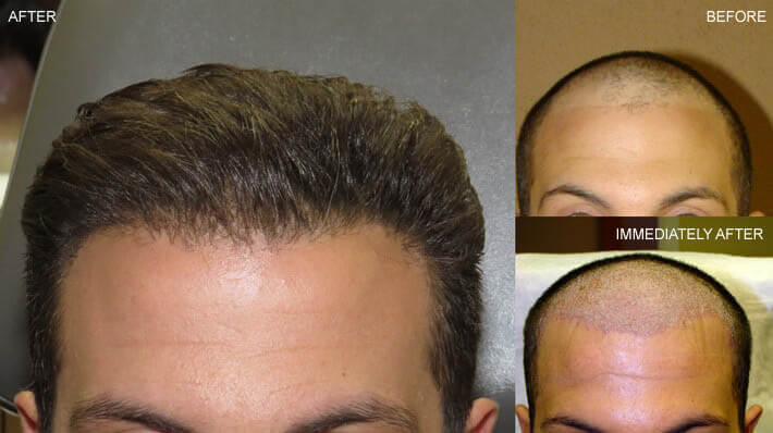 hair-transplantation-a-z
