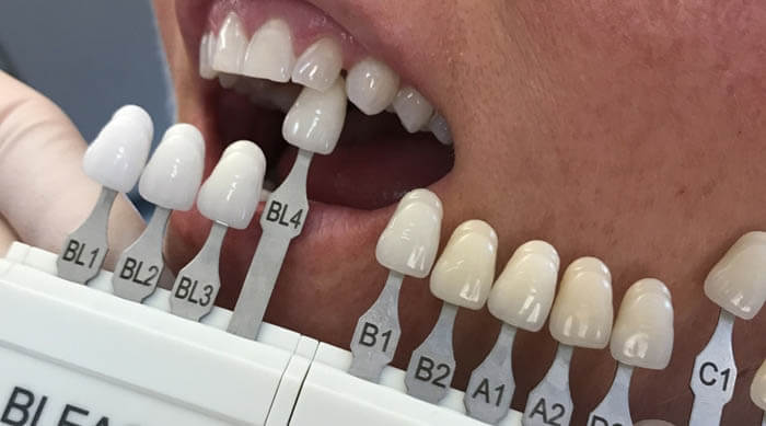 whitening-teeth-shades-1