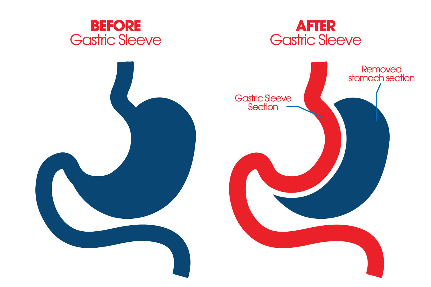gastric-sleeve-2