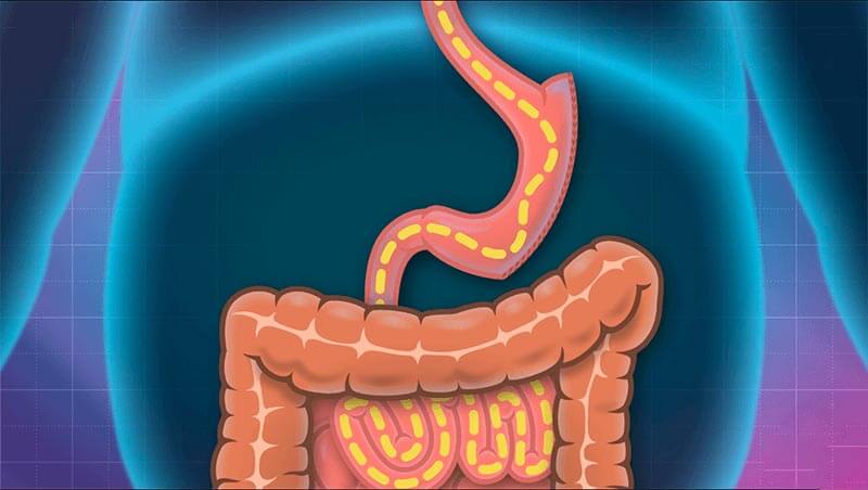 gastric-sleeve2342