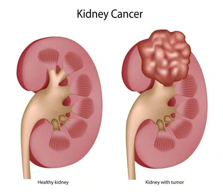 kidney-cancer-768x660-jpg-optimal