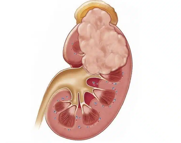 kidney-cancer-2