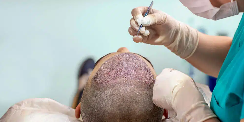 14001026 hair transplants For web
