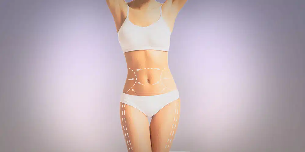 How is Liposuction done on the Stomach