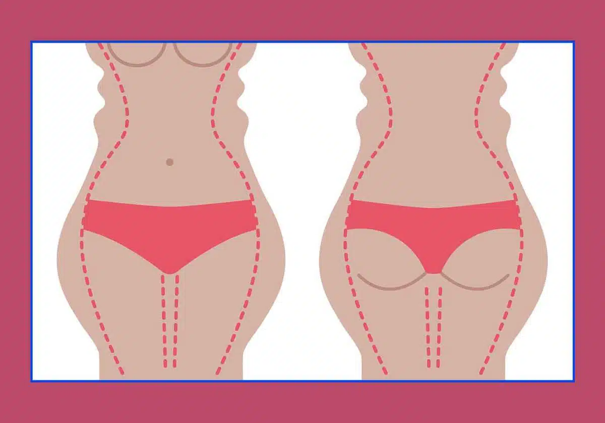 liposuction-liposculpture