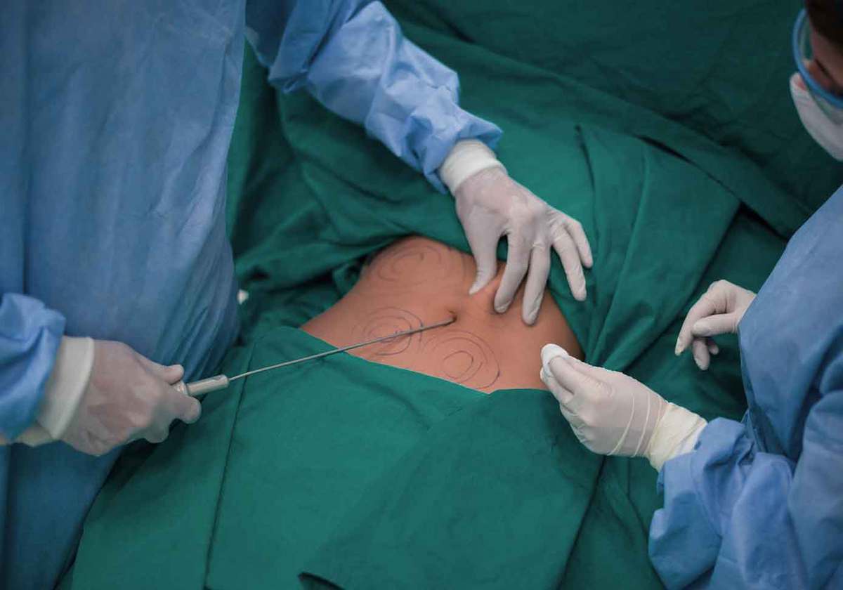Liposuction Risks