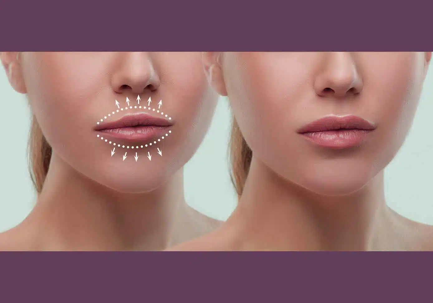 what-should-you-do-before-injecting-fillers