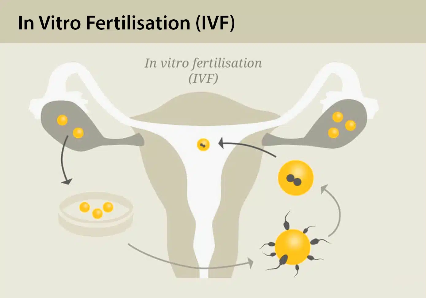 IVF procedure