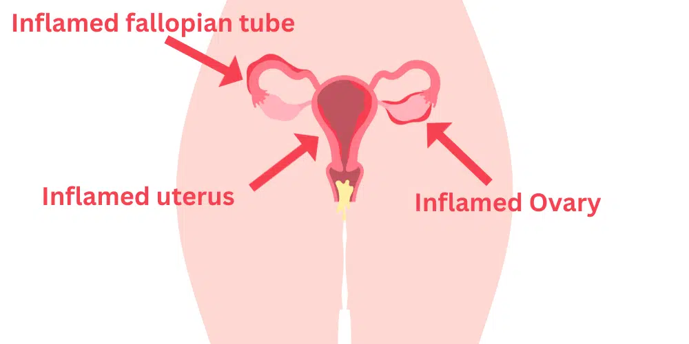 pelvic inflammatory disease 